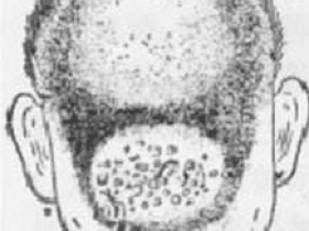 历史上患“疽”而死的人物有哪些?“疽”是一种怎样的病症?