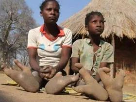 脚趾畸形的非洲部落 出生时只有两个脚趾